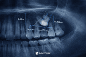 The Hidden Challenge: A Complete Guide to Impacted Teeth, Orthodontic Exposure, and Braces Traction