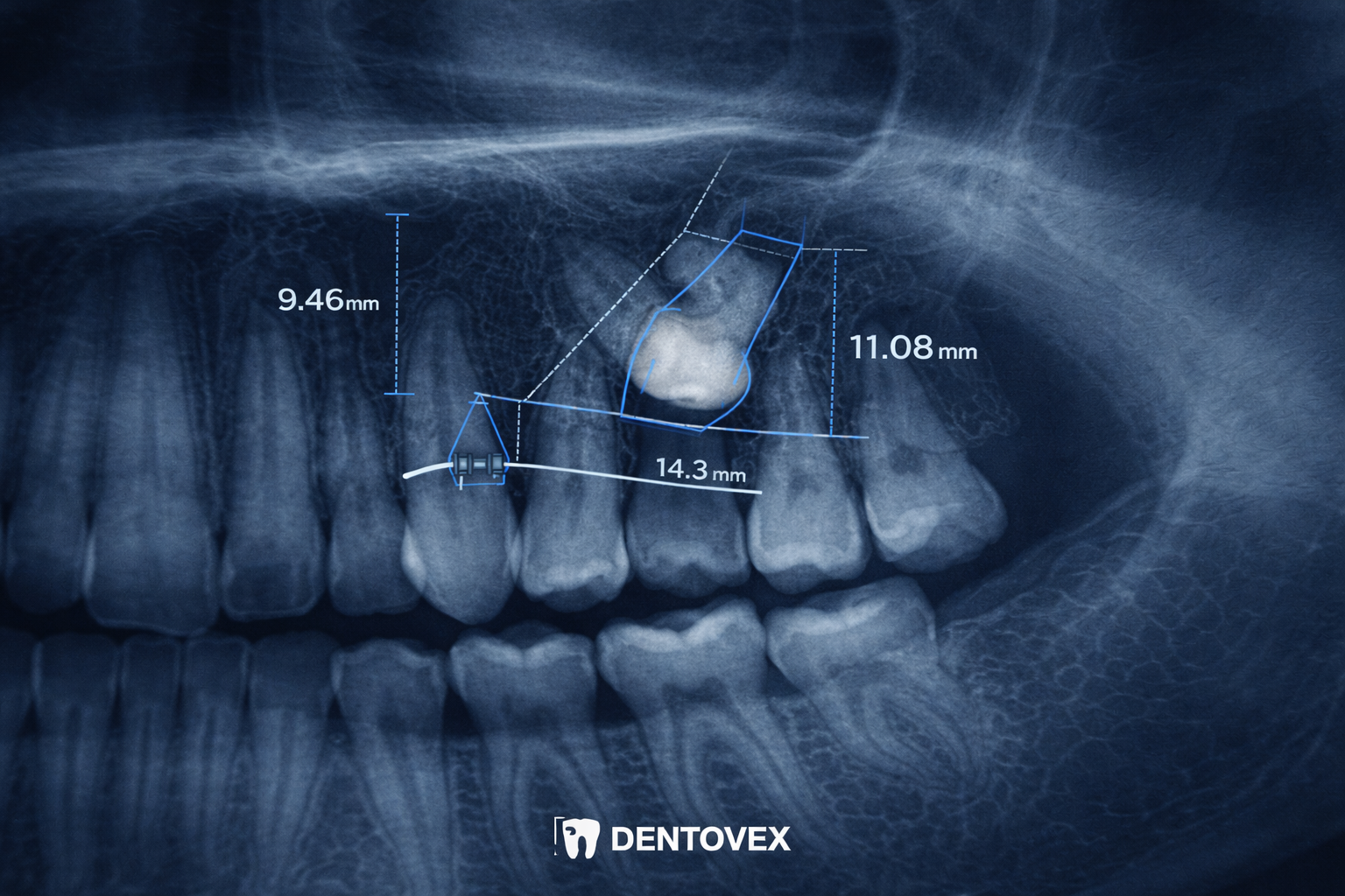 The Hidden Challenge: A Complete Guide to Impacted Teeth, Orthodontic Exposure, and Braces Traction