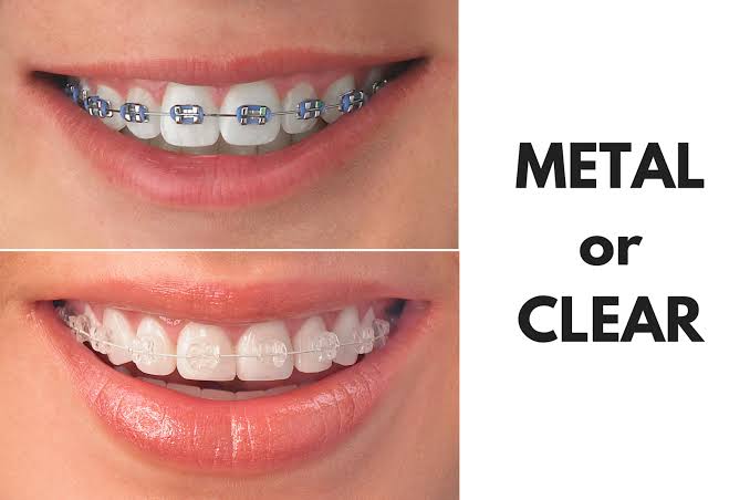 Clear Braces Versus Metal Braces