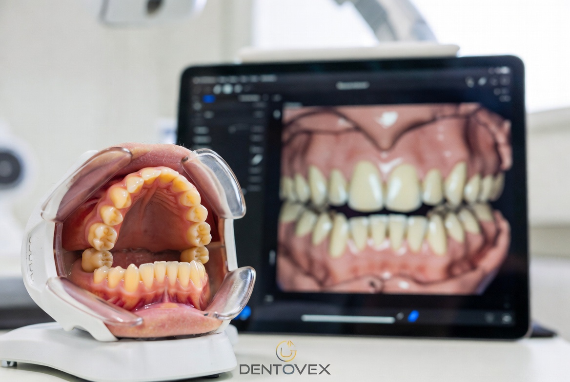 Open Bite Teeth - Dentovex