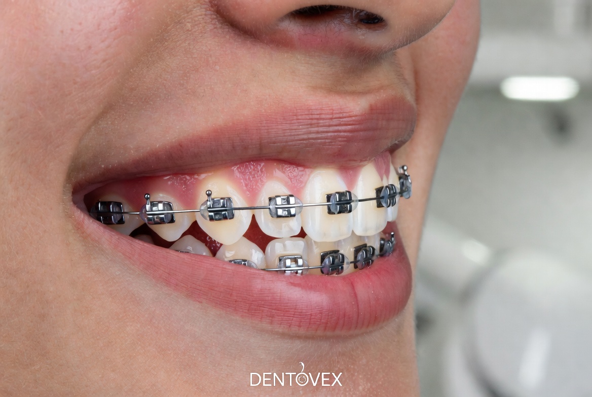 Transparent Teeth Braces: A Comprehensive Guide to Clear Brackets, Sapphire Aesthetics, and Invisible Orthodontic Engineering