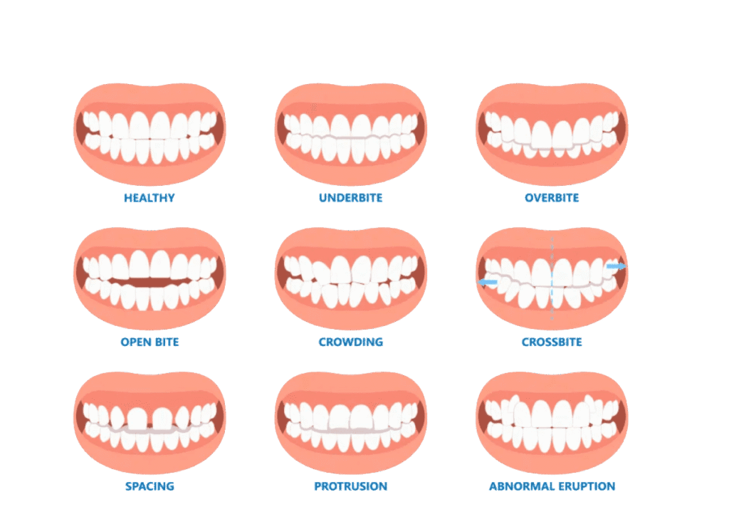 Clear Aligners for Overbite: Clinical Efficacy, Methods & Cost